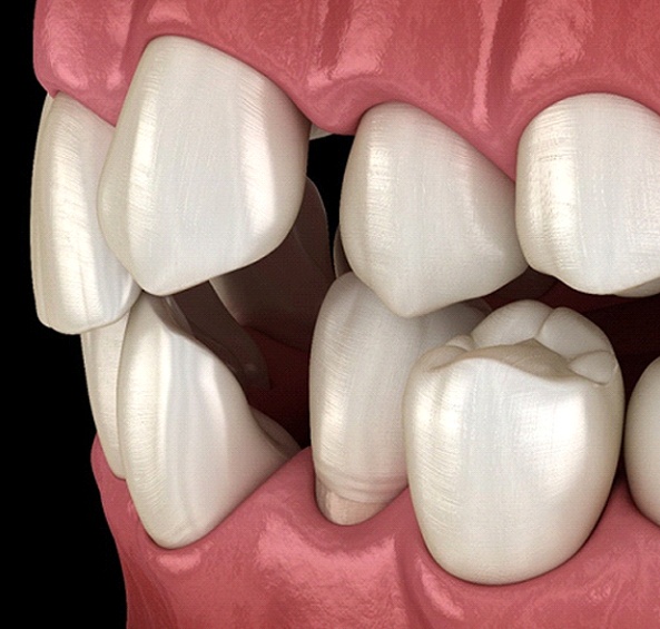 An up-close, digital view of crooked teeth