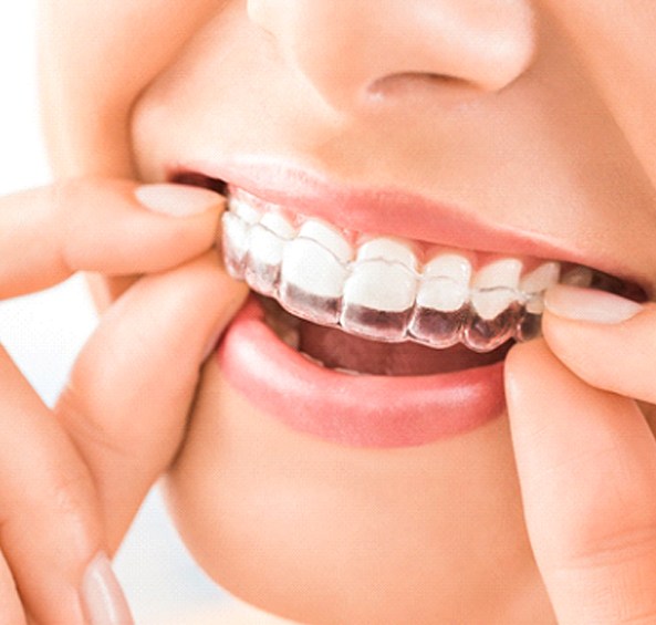 An up-close image of a woman reinserting her Invisalign aligner