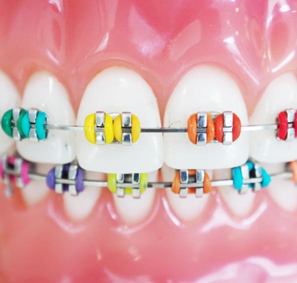 Closeup of a model mouth wearing very colorful traditional braces in Frisco