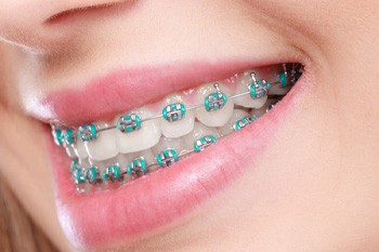 Closeup of female patient wearing traditional metal braces in Frisco