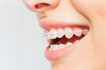 Closeup of a patient wearing nearly invisible clear braces in Frisco