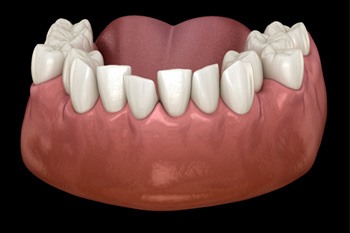 Digital illustration of a lower jaw with crooked teeth in Frisco 