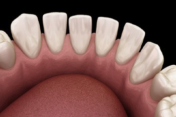 Digital illustration of a lower jaw with gaps between teeth in Frisco 