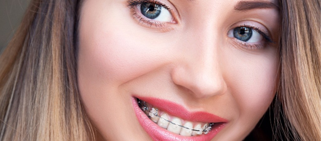 Closeup of young woman wearing clear ceramic braces in Frisco