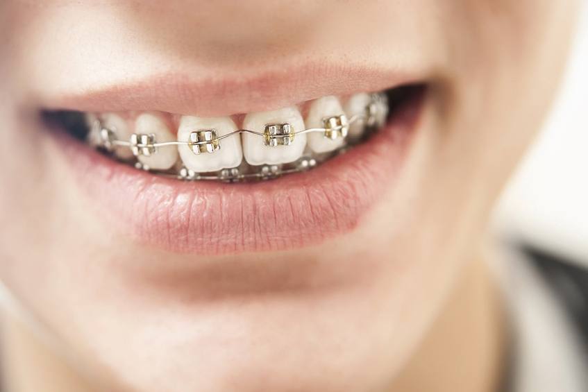 Close-up of young boy’s teeth with braces