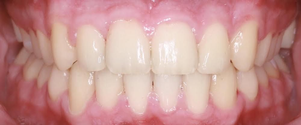 Closeup of corrected smile after orthodontics