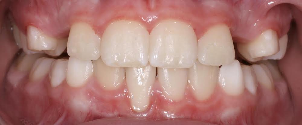 Closeup of properly aligned teeth and bite