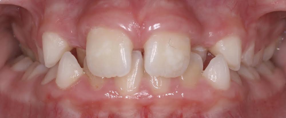 Closeup of teeth front and back crossbite and crowding
