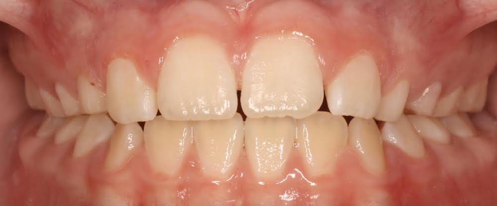 Closeup of smile after treatment with habit appliance