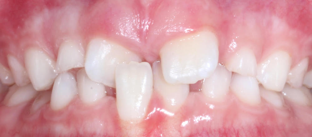Closeup of smile with anterior crossbite and crowding