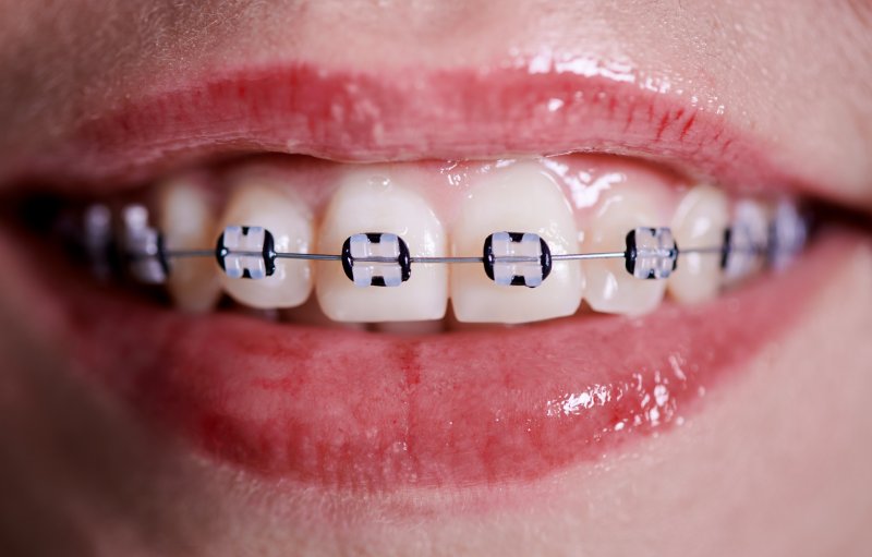 braces on top row of teeth