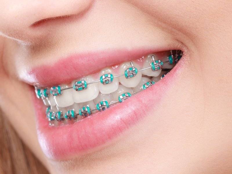 smiling person with braces
