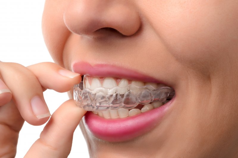 Young woman putting on an Invisalign aligner